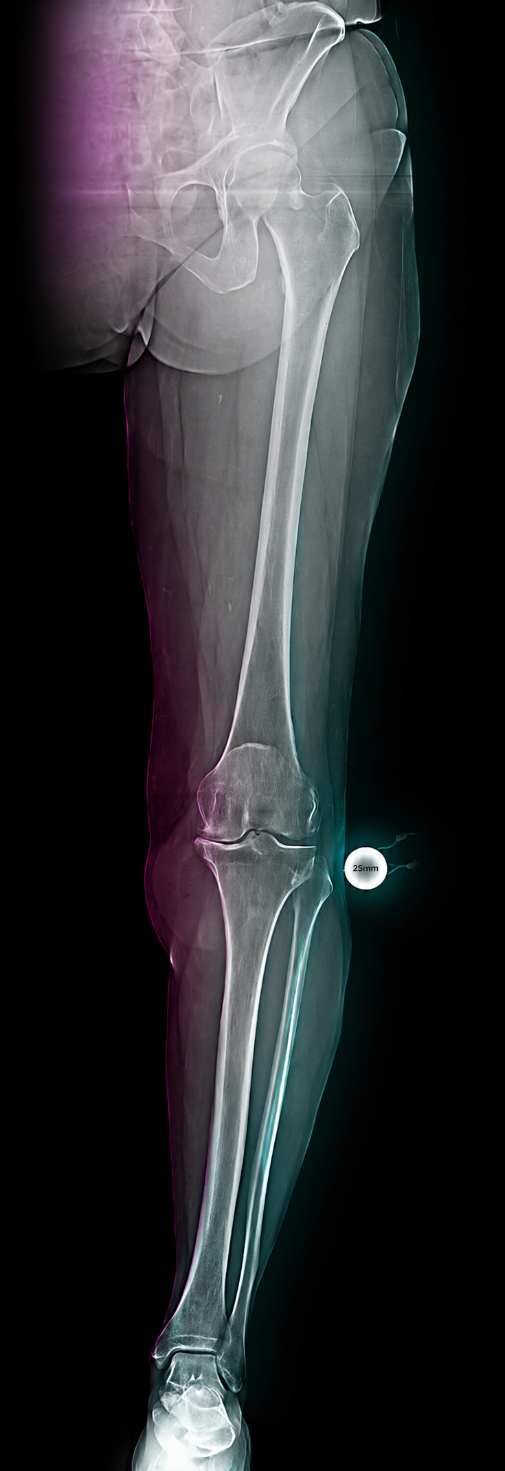 Standing long-leg AP