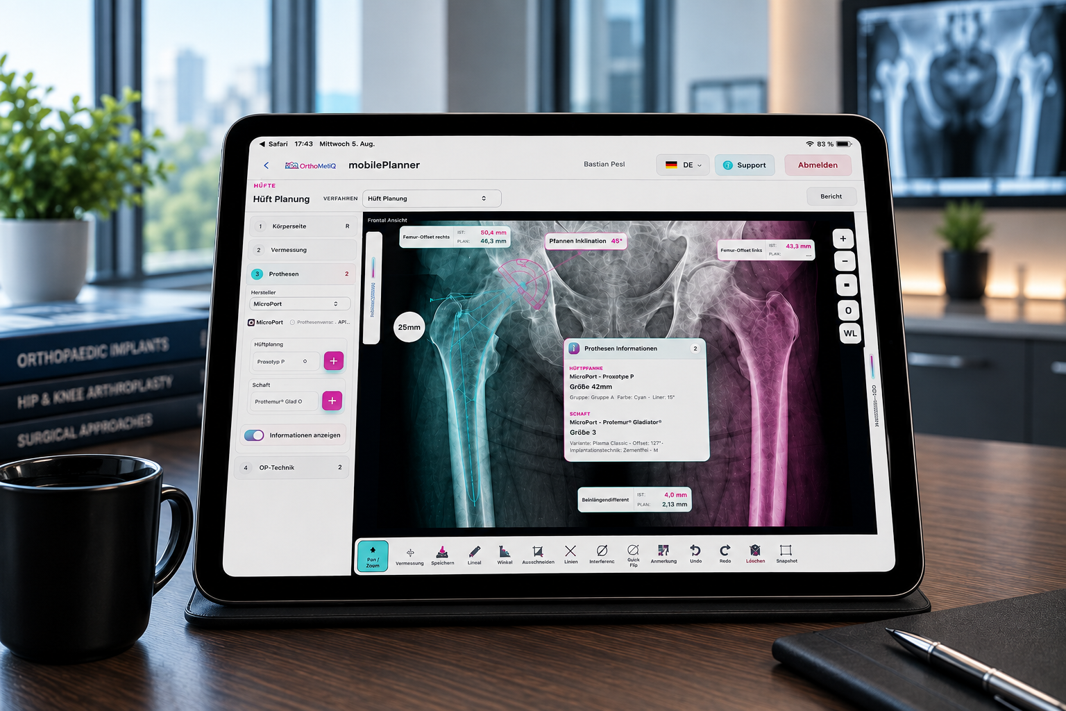 OrthoMetiQ mobilePlanner – Preoperative Planning Goes Mobile